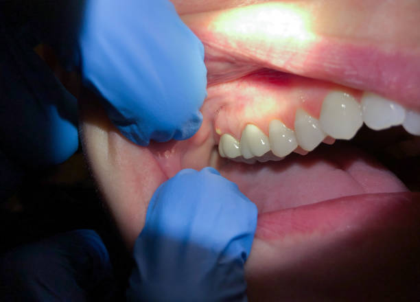 Best Emergency Treatment for Oral Infections in Philadelphia, MS